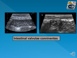 Intestinal valvulae conniventes
 
