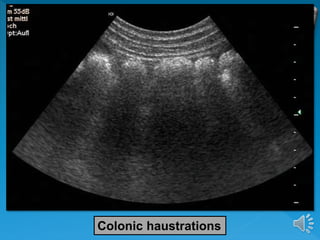 Colonic haustrations
 