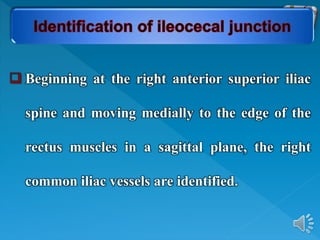  Beginning at the right anterior superior iliac
spine and moving medially to the edge of the
rectus muscles in a sagittal plane, the right
common iliac vessels are identified.
 