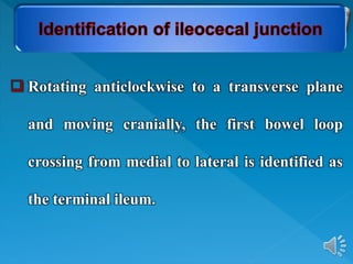  Rotating anticlockwise to a transverse plane
and moving cranially, the first bowel loop
crossing from medial to lateral is identified as
the terminal ileum.
 