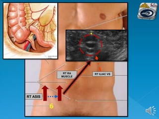 RT ASIS
RT RA
MUSCLE
RT ILIAC VS
 