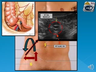 RT RA
MUSCLE
RT ILIAC VS
 