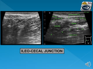 ILEO-CECAL JUNCTION
 