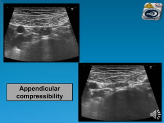 Appendicular
compressibility
 