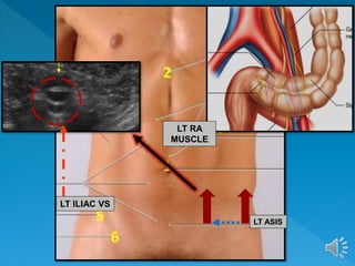 LT ASIS
LT ILIAC VS
LT RA
MUSCLE
 