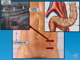 LT RA
MUSCLE
LT ILIAC VS
SIGMOID
COLON
 