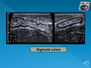 Sigmoid colon
 