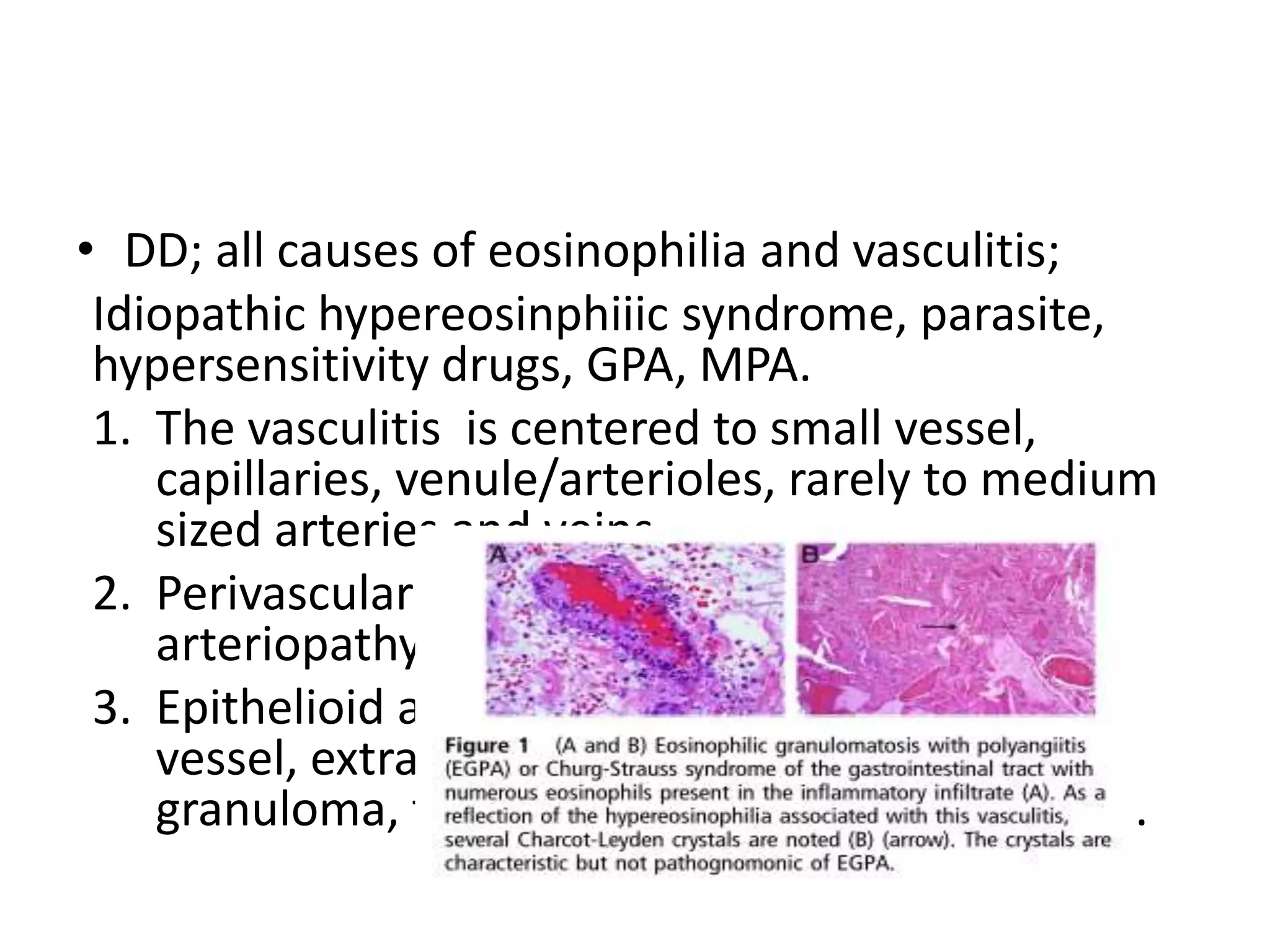 • DD; all causes of eosinophilia and vasculitis;
Idiopathic hypereosinphiiic syndrome, parasite,
hypersensitivity drugs, GPA, MPA.
1. The vasculitis is centered to small vessel,
capillaries, venule/arterioles, rarely to medium
sized arteries and veins.
2. Perivascular eosinophilia infiltration,
arteriopathy > true vasculitis.
3. Epithelioid and giant cells are found around
vessel, extravascular eosinophilia rich
granuloma, that spills over surrounding tissue.
 