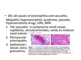 • DD; all causes of eosinophilia and vasculitis;
Idiopathic hypereosinphiiic syndrome, parasite,
hypersensitivity drugs, GPA, MPA.
1. The vasculitis is centered to small vessel,
capillaries, venule/arterioles, rarely to medium
sized arteries and veins.
2. Perivascular eosinophilia infiltration,
arteriopathy > true vasculitis.
3. Epithelioid and giant cells are found around
vessel, extravascular eosinophilia rich
granuloma, that spills over surrounding tissue.
 
