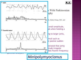 o 9 out 11 MSA-P patients presented abnormal, small-amplitude,
nonrhythmic movements of the fingers or hands when holding a
posture or at the beginning of an action;
o Involvement of proximal arm segments, leading to larger jerks,
occurred only occasionally
o During maintenance of a posture, external stimuli such as
cutaneous pinprick with a sharpened object or passive sudden
stretch elicited reflex jerks in all 9 patients
o Neurophysiological investigations have demonstrated that jerky
postural tremor in MSA consists of small-amplitude irregular
oscillations with no predominant peak in the fast Fourier frequency
spectrum analyses
Minipolymyoclonus
 