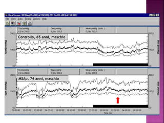 Controllo, 65 anni, maschio
MSAp, 74 anni, maschio
 