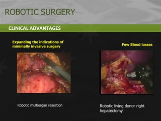 Expanding the indications of minimally invasive surgery Robotic living donor right hepatectomy Few Blood losses CLINICAL ADVANTAGES Robotic multiorgan resection ROBOTIC SURGERY 