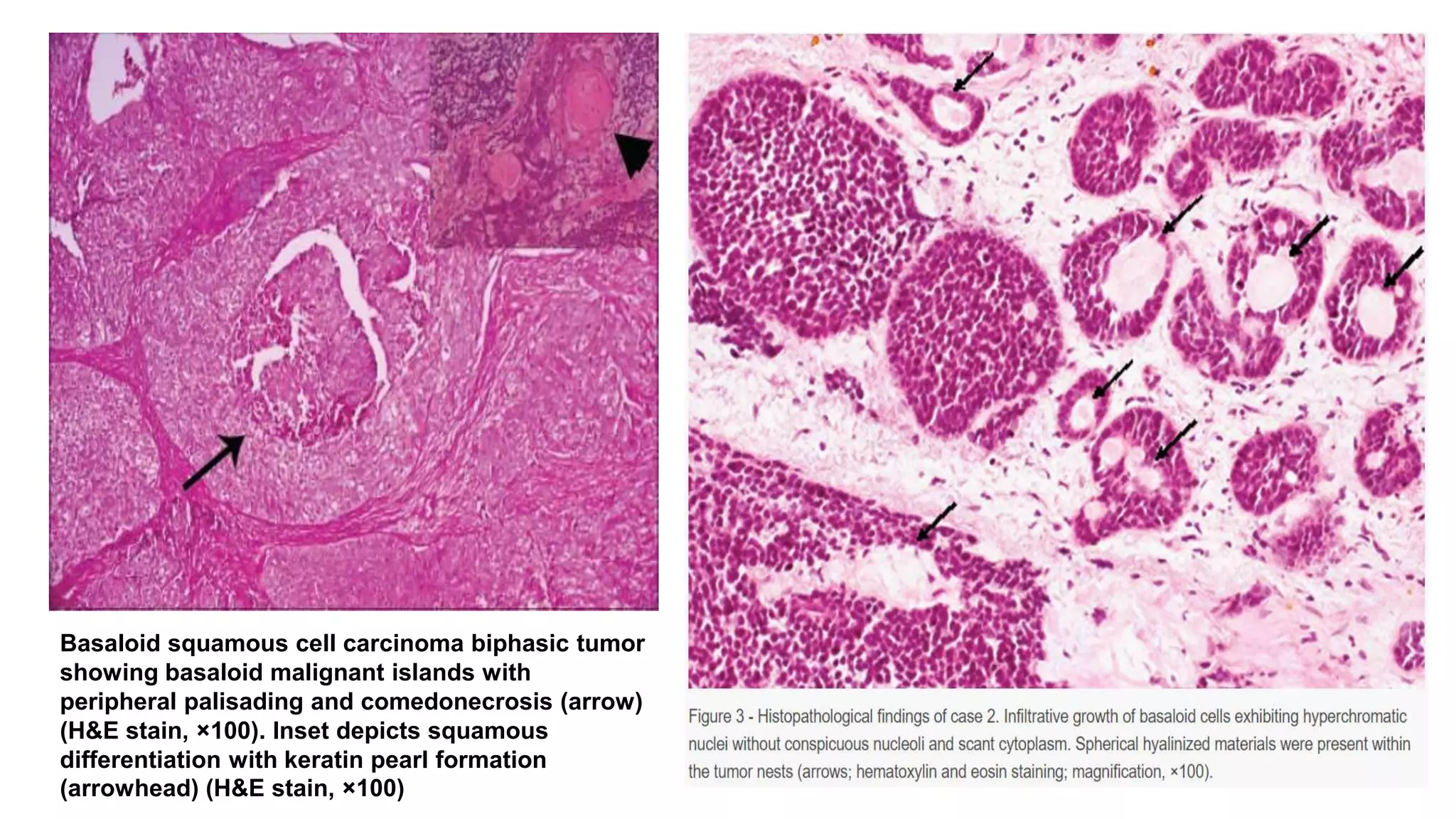 Histopathological variants of squamous cell carcinoma (Doctor Faris ...