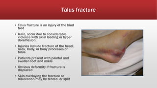 Talus fracture
▪ Talus fracture is an injury of the hind
foot
▪ Rare, occur due to considerable
violence with axial loading or hyper
dorsiflexion.
▪ Injuries include fracture of the head,
neck, body, or bony processes of
talus.
▪ Patients present with painful and
swollen foot and ankle
▪ Obvious deformity if fracture is
displaced
▪ Skin overlaying the fracture or
dislocation may be tented or split
 