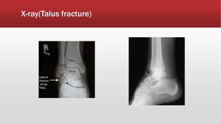 X-ray(Talus fracture)
 