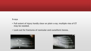 X-rays
▪ Full extent of injury hardly clear on plain x-ray; multiple vies of CT
may be needed.
▪ Look out for fractures of navicular and cuneiform bones.
 