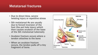 Metatarsal fractures
▪ Due to direct blow, severe
twisting injury or repetitive stress
▪ 5th metatarsal #s are usually
due to forced inversion of the
foot (the pot hole injury) which
then causes avulsion of the base
of the 5th metatarsal tuberosity
▪ Avulsion fracture occurs where a
tendon attaches to the bone
▪ When an avulsion fracture
occurs, the tendon pulls off a tiny
fragment of bone.
 