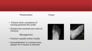 Presentation
▪ Patient often complains of
having sprained the ankle
▪ Tenderness marked over area of
fracture.
Management
▪ Fracture usually unites readily
▪ Immobilisation in a below knee
plaster for 4 weeks is advised
X-rays
 