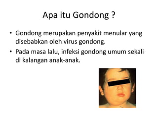 Apa itu Gondong ?
• Gondong merupakan penyakit menular yang
disebabkan oleh virus gondong.
• Pada masa lalu, infeksi gondong umum sekali
di kalangan anak-anak.
 