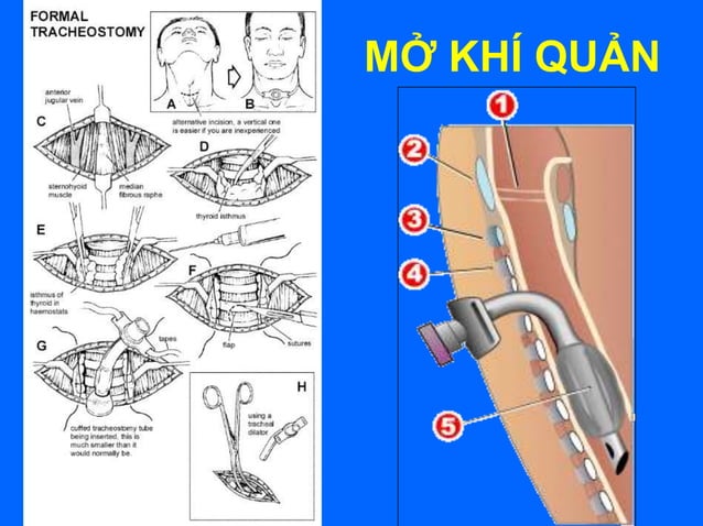 Cap cuu ban_dau | PPT