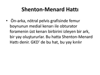 Shenton-Menard Hattı
• Ön-arka, nötral pelvis grafisinde femur
  boynunun medial kenarı ile obturator
  foramenin üst kenarı birbirini izleyen bir ark,
  bir yay oluştururlar. Bu hatta Shenton-Menard
  Hattı denir. GKD’ de bu hat, bu yay kırılır
 