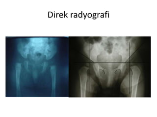 Direk radyografi
 