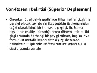 Von-Rosen I Belirtisi (Süperior Deplasman)

• Ön-arka nötral pelvis grafisinde Hilgenreiner çizgisine
  parelel olacak şekilde simfizis pubisin üst kenarından
  teğet olarak ikinci bir transvers çizgi çizilir. Femur
  başlarının ossifiye olmadığı erken dönemlerde bu iki
  çizgi arasında herhangi bir şey görülmez, boş kalır ve
  femur üst metafiz kenarı alttaki çizgi ile temas
  halindedir. Displazide ise femurun üst kenarı bu iki
  çizgi arasında yer alır
 