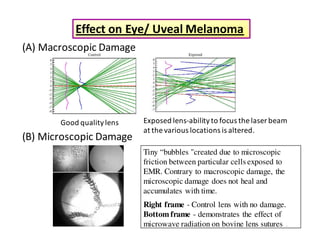 Effect on Eye/ UvealMelanoma 
Good quality lens Exposed lens-ability to focus the laser beam 
at the various locations is altered. 
Tiny “bubbles created due to microscopic 
friction between particular cells exposed to 
EMR. Contrary to macroscopic damage, the 
microscopic damage does not heal and 
accumulates with time. 
Right frame - Control lens with no damage. 
Bottom frame - demonstrates the effect of 
microwave radiation on bovine lens sutures . 
(A) Macroscopic Damage 
(B) Microscopic Damage 
 