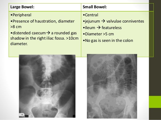 intestinal obstruction