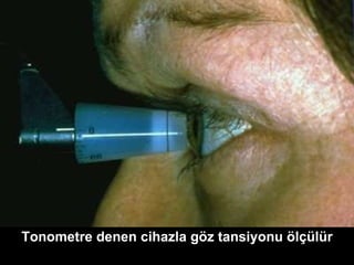 Tonometre denen cihazla göz tansiyonu ölçülür 