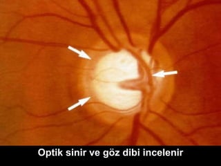 Optik sinir ve göz dibi incelenir 