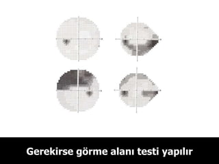 Gerekirse görme alanı testi yapılır 