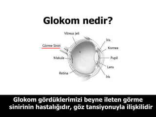 Glokom nedir? Glokom gördüklerimizi beyne ileten görme sinirinin hastalığıdır, göz tansiyonuyla ilişkilidir 