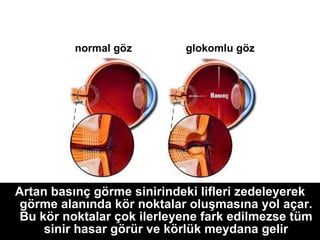 Artan basınç görme sinirindeki lifleri zedeleyerek görme alanında kör noktalar oluşmasına yol açar. Bu kör noktalar çok ilerleyene fark edilmezse tüm sinir hasar görür ve körlük meydana gelir normal göz glokomlu göz 