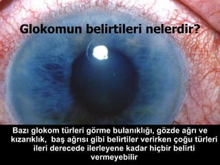 Glokomun belirtileri nelerdir? Bazı glokom türleri görme bulanıklığı, gözde ağrı ve kızarıklık,  baş ağrısı gibi belirtiler verirken çoğu türleri ileri derecede ilerleyene kadar hiçbir belirti vermeyebilir 