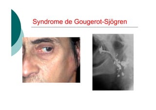 Syndrome de Gougerot-Sjögren