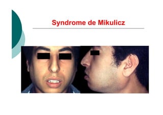 Syndrome de Mikulicz