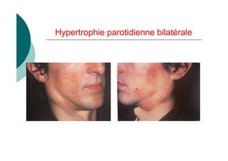 Hypertrophie parotidienne bilatérale