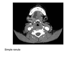 Bilateral Ranula Radiology Diagnostic Imaging of Salivary, Parathyroid and Thyroid Glands | PPT