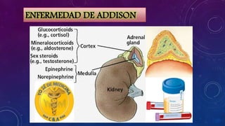 ENFERMEDAD DE ADDISON

 