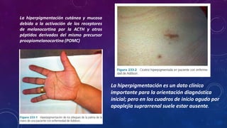 La hiperpigmentación cutánea y mucosa
debida a la activación de los receptores
de melanocortina por la ACTH y otros
péptidos derivados del mismo precursor
proopiomelanocortina (POMC)

La hiperpigmentación es un dato clínico
importante para la orientación diagnóstica
inicial; pero en los cuadros de inicio agudo por
apoplejía suprarrenal suele estar ausente.

 