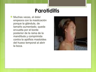 Parotiditis
 Muchas veces, el dolor
empeora con la masticación
porque la glándula, de
tamaño aumentado, queda
envuelta por el borde
posterior de la rama de la
mandíbula y comprimida
contra la apófisis mastoides
del hueso temporal al abrir
la boca.
 
