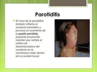 Parotiditis
 EI virus de la parotiditis
también inflama el
conducto parotídeo y
provoca un enantema de
la papila parótida,
pequeña proyección
mamilar que señala el
orificio de
desembocadura del
conducto en la
membrana malar dentro
de la cavidad bucal.
 