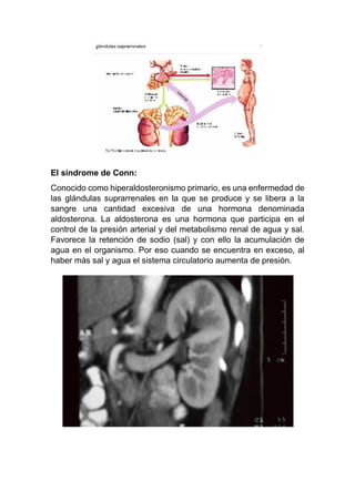 El síndrome de Conn:
Conocido como hiperaldosteronismo primario, es una enfermedad de
las glándulas suprarrenales en la que se produce y se libera a la
sangre una cantidad excesiva de una hormona denominada
aldosterona. La aldosterona es una hormona que participa en el
control de la presión arterial y del metabolismo renal de agua y sal.
Favorece la retención de sodio (sal) y con ello la acumulación de
agua en el organismo. Por eso cuando se encuentra en exceso, al
haber más sal y agua el sistema circulatorio aumenta de presión.
 