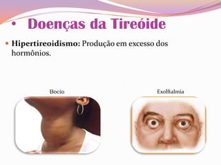 • Doenças da Tireóide
 Hipertireoidismo: Produção em excesso dos
hormônios.
Bocío Exolftalmia
 