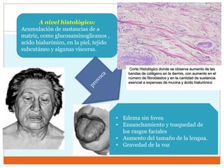 A nivel histológico:
Acumulación de sustancias de a
matriz, como glucosaminoglicanos ,
acido hialurónico, en la piel, tejido
subcutáneo y algunas vísceras.
• Edema sin fovea
• Ensanchamiento y tosquedad de
los rasgos faciales
• Aumento del tamaño de la lengua.
• Gravedad de la voz
Corte Histológico donde se observa aumento de las
bandas de colágeno en la dermis, con aumento en el
número de fibroblastos y en la cantidad de sustancia
esencial a expensas de mucina y ácido hialurónico
 