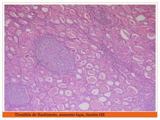 Tiroiditis de Hashimoto, aumento lupa, tinción HE
 