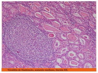 Tiroiditis de Hashimoto, aumento mediano, tinción HE.
 