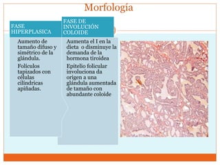Morfología
Aumenta el I en la
dieta o disminuye la
demanda de la
hormona tiroidea
Epitelio folicular
involuciona da
origen a una
glándula aumentada
de tamaño con
abundante coloide
FASE DE
INVOLUCIÓN
COLOIDE
Aumento de
tamaño difuso y
simétrico de la
glándula.
Folículos
tapizados con
células
cilíndricas
apiñadas.
FASE
HIPERPLASICA
 