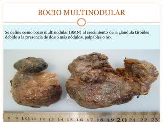 BOCIO MULTINODULAR
Se define como bocio multinodular (BMN) al crecimiento de la glándula tiroides
debido a la presencia de dos o más nódulos, palpables o no.
 